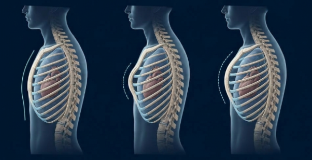 Ilustração anatômica comparando tórax normal, Pectus excavatum e Pectus carinatum